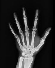 an X-ray of a hand an X-ray of a hand